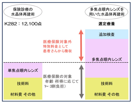 多焦点眼内レンズについて